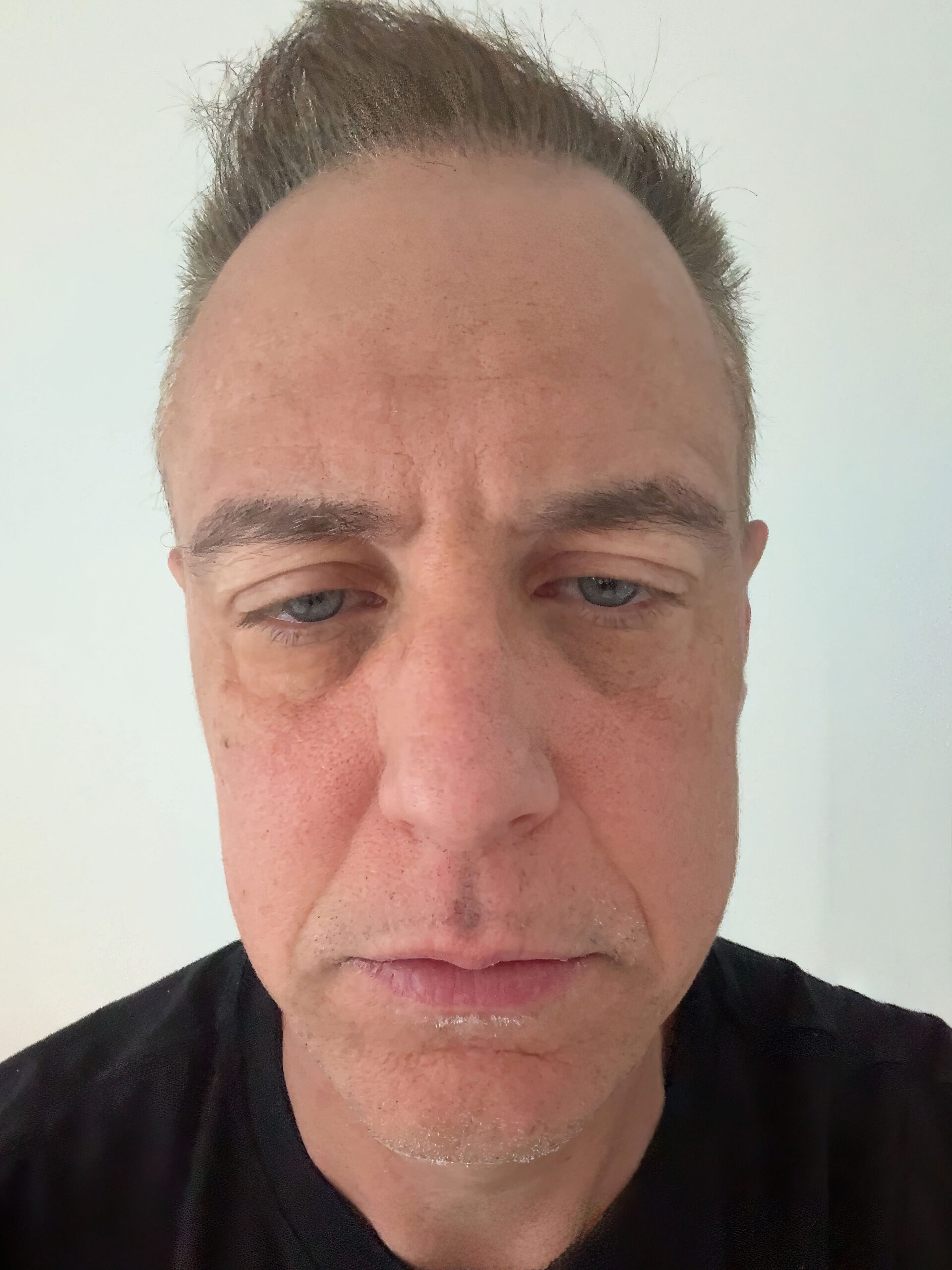 Long COVID ME/CFS Chronic Fatigue